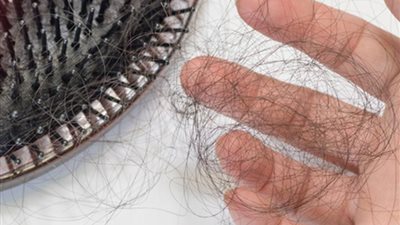 هل الصلع الوراثي مقتصر على الرجال؟