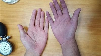  سبب ازرقاق اليدين في الشتاء.. حسام موافي يجيب 