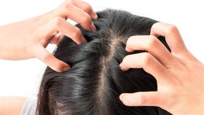 وصفة لقشرة الشعر بـ 4 خلطات طبيعية فعالة من أول استخدام