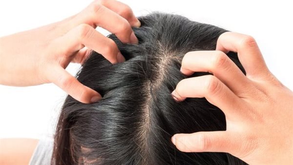 وصفة لقشرة الشعر