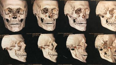 صحة المنوفية: نجاح عملية جراحية دقيقة لإصلاح كسور الفك السفلي بمستشفى أشمون 