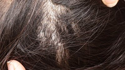 لو أبيض استبشر.. تفسير حلم وجود قمل في الشعر للرجل والمرأة