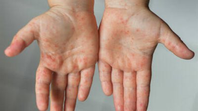 خبراء يوضحون فوائد العلاج الطبيعي لـ مرضى شلل الرعاش 