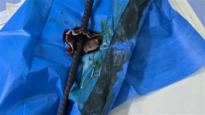استخراج سيخ حديدي بطول 60 سنتيمترا اخترق ظهر عامل بناء في مستشفى المحلة