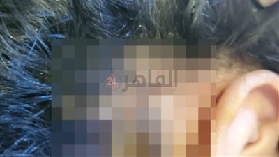 ضربت بآلة حادة على الرأس.. التقرير الطبي لواقعة تعدي طالبة على زميلتها في مدرسة أجنبية شهيرة بالشروق