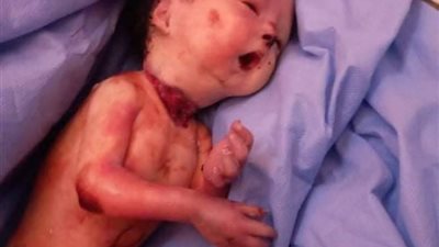 بعد رضيع بعين واحدة.. ولادة طفل بذبح في الرقبة بالأقصر