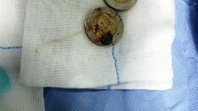 عمرها 6 سنوات.. فريق طبي بقنا يستخرج جنيهين معدن من مرىء طفلة (صور)