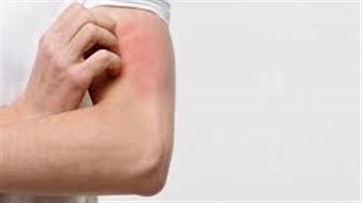 أبرزها جفاف الجلد.. ما هو مرض التهاب الجلد التأتبي وأعراضه؟