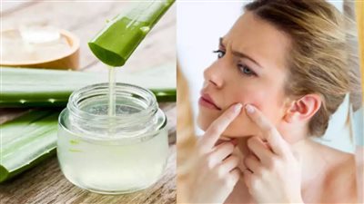 كيف يساعد جل الصبار في التخلص من حب الشباب؟