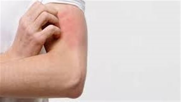  التهاب الجلد التأتبي