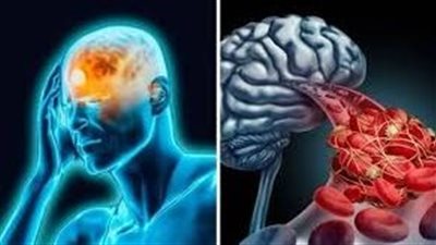 تعرف على أعراض الإصابة بتجلط الجيوب الأنفية الوريدية الدماغية والفئات الأكثر عرضة للمرض