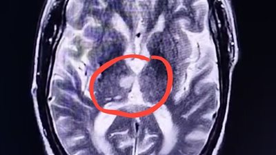 حالة نادرة بمصر.. مسن يدخل في نوم عميق لفترة طويلة بسبب جلطة دماغية| خاص