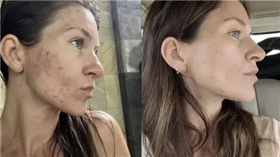 هل يمكن للفيروسات أن تكون علاجًا لحب الشباب؟