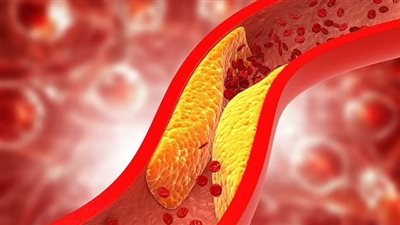 الكوليسترول الجيد HDL يصيب بالعمى| دراسة 