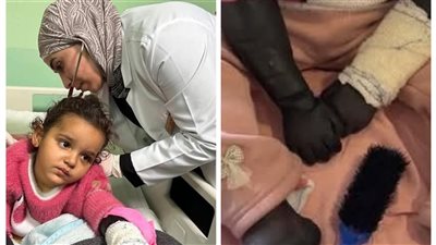 بعد إقرار الأطباء بضرورة بتر أطرافها.. عم الصغيرة الفلسطينية حبيبة: حالتها بتسوء ومفيش قدامنا غير الصبر