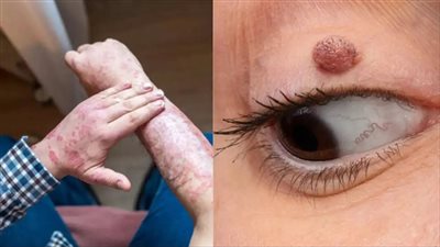 أعراض ارتفاع الكوليسترول تظهر على الجلد.. تعرف على التفاصيل 