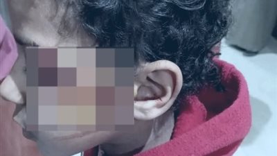 بدأت بخناقة على المقعد وانتهت بـ 12 غرزة في الوجه.. تفاصيل إصابة تلميذ على يد 2 آخرين بـ موس في مدرسة بسوهاج