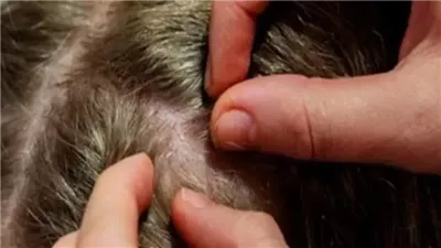 تفسير حلم قمل في الشعر.. وقوعه على الأرض يحمل رسالة تحذير