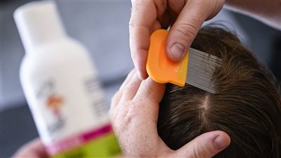 تفسير حلم القمل في الشعر وقتله.. بعض الإشارات تفيدك في الواقع