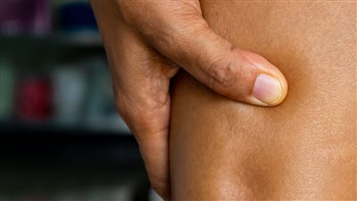 وباء الوذمة الشحمية.. مرض مزمن تعاني منه ملايين النساء