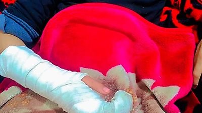 كسر إيده وخلاه يعيط طول الليل.. مدرس ابتدائي بسوهاج يضرب تلميذًا بقسوة بسبب الحمام| صور