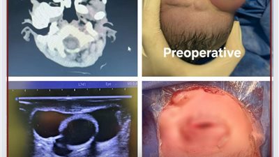 عمرها يوم واحد.. نجاح عملية استئصال ورم نادر من عين رضيعة بمستشفيات جامعة عين شمس