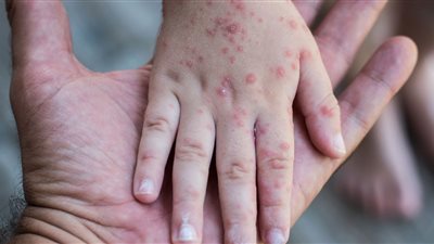 ظهور 12 حالة إصابة بجدري مائي في مدرسة بالجيزة.. ومصدر بالتعليم: أصيبوا خارج المدرسة ولا داعي للقلق| خاص