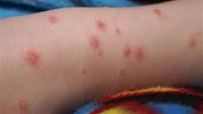 إصابة 12 طالبا بالجدري المائي داخل مدرسة تجريبي بالعمرانية | بث مباشر 