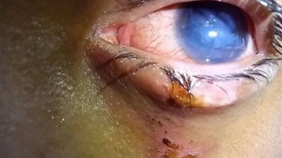 إصابة 3 أشخاص في العين بسبب الألعاب النارية بسوهاج