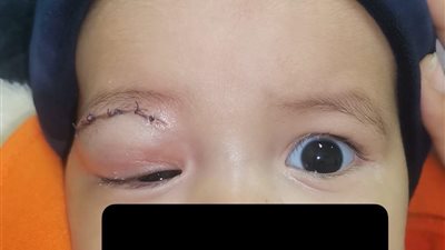 إنقاذ عين رضيعة تعاني من ورم بحجاج العين اليمنى بجامعة سوهاج