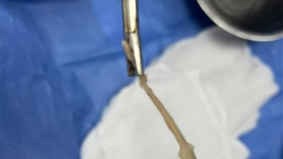 استخراج عظمة بطة من بلعوم مريض باستخدام المنظار في مستشفى بئر العبد