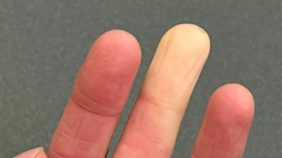 علامة على مرض خطير.. خبراء يحذرون من تغير لون الجلد 