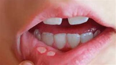 هل يوجد علاج نهائي لـ الهربس؟.. تعرف على أعراضه عند الأطفال والكبار