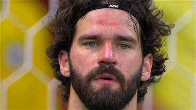 اشتباه بارتجاج في المخ.. طبيب المنتخب البرازيلي يكشف تفاصيل إصابة أليسون