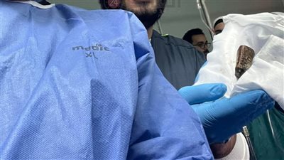 ظلت في معدته 18 شهرًا.. استخراج 3 حجارة قلم من بطن مريض بالمنوفية 