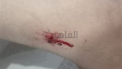 أول وثاني أيام العيد.. إصابة 59 شخصًا بعقر الكلاب الضالة في السويس