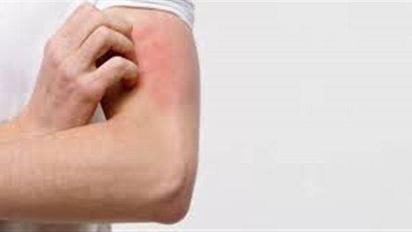  التهاب الجلد التأتبي