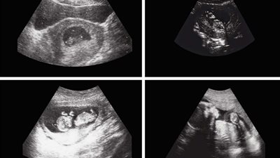 عملية جراحية نادرة.. استخراج جنين من بطن رضيع في أفغانستان