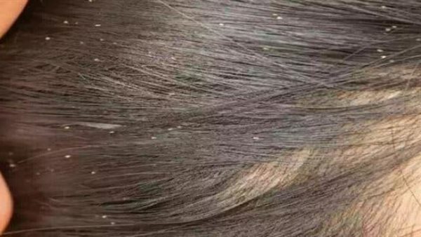 تفسير حلم نزع القمل