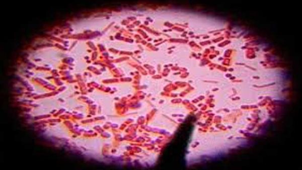 الجمرة الخبيثة 