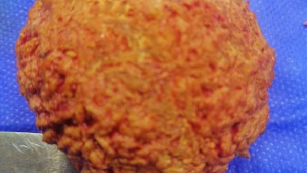 الحصوة بعد استخراجها