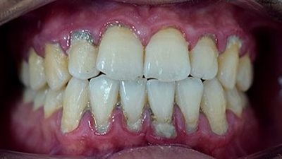 طبيب أسنان يحذر: احتمالية الوفاة بسبب جير الأسنان نتيجة انتقال البكتيريا من الفم للقلب والمخ