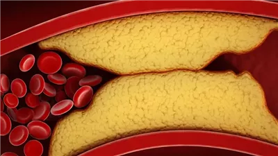 اكتشاف دواء تجريبي يخفّض مستويات البروتين الدهني ويقلل الإصابة بالسكتات الدماغية