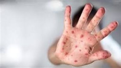 علماء يتوقعون ظهور فيروس جدري الماموث من الجليد بسبب تغيرات المناخ