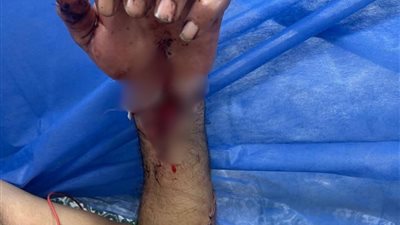 استغرقت 12 ساعة.. نجاح عملية دقيقة لإعادة توصيل يد مبتورة بمجمع السويس الطبي