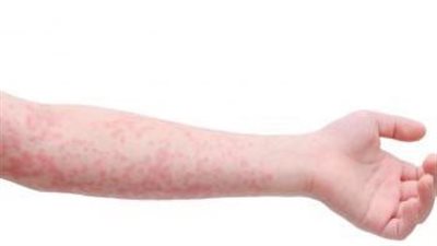 الأعلى منذ 30 عامًا.. أمريكا تشهد أسوأ موجات تفشي الحصبة