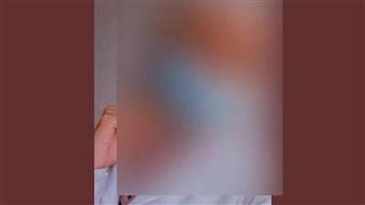 ممرضة تتعرض للاعتداء من أهلية مريضة بمستشفى خاص: ضربوني بكرسي متحرك وأهانوني في مكان عملي