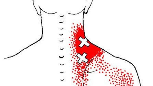 العقد العضلية 