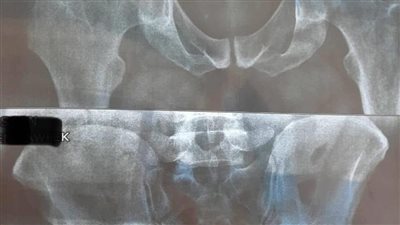 فريق طبي بمستشفى الخانكة ينجح في إجراء 30 عملية تغيير مفصل صناعي