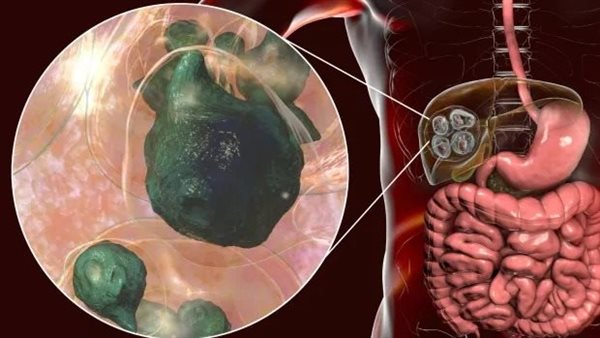 داء الكيسات السنخية